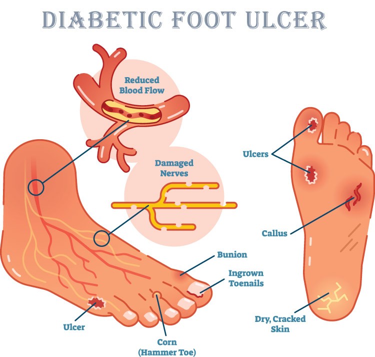 clinical presentation of diabetic ulcer