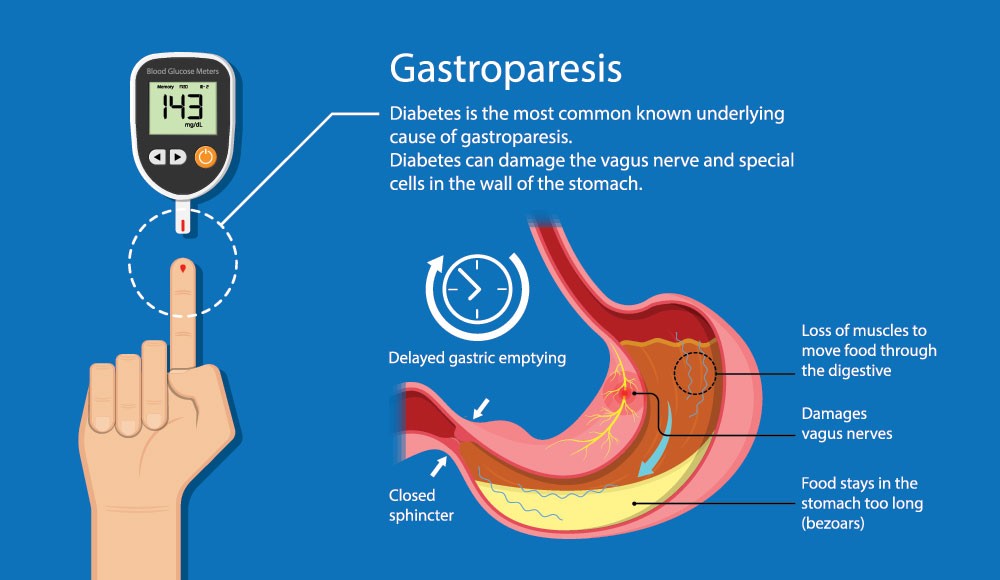 Diabetic Gastroparesis Symptoms Diagnoses And Treatment Breathe 