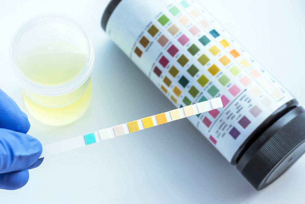 Measuring Sugar In Urine Know About Test Procedure And Result 